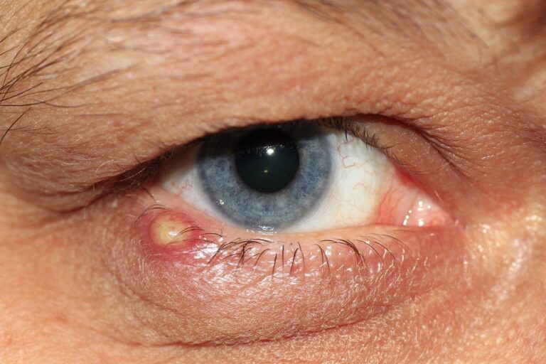 आंख में गुहेरी के कारण, लक्षण और घरेलू उपाय
